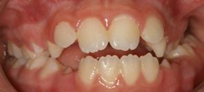 מנשך הפוך באזור השיניים הקדמיות וחוסר מקום לשן קדמית.