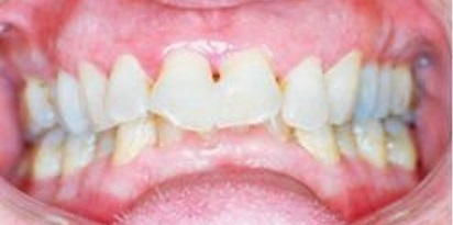 לפני ישור שיניים מוצלח במרפאת גזית