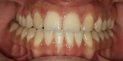 תמונה לאחר יישור שיניים במרפאת גזית ברמת גן