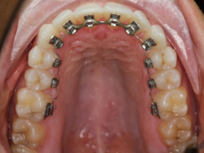 סוג 1 של סמכים פנימיים לשיניים