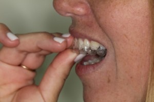 יישור שיניים שקוף - הרכבת פלטה שקופה לשיניים