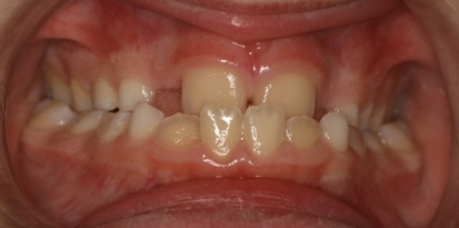 תמונה שיניים לפני יישור לילדים
