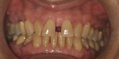תמונה לפני יישור של השיניים מוצלח לגיל מבוגר