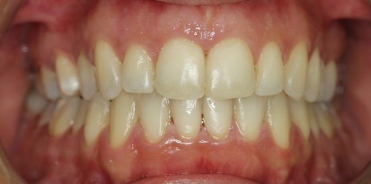 שימוש בטבעות לשיניים - אורתודונטיה