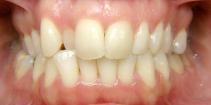 לפני יישור שיניים עם טבעות שקופות