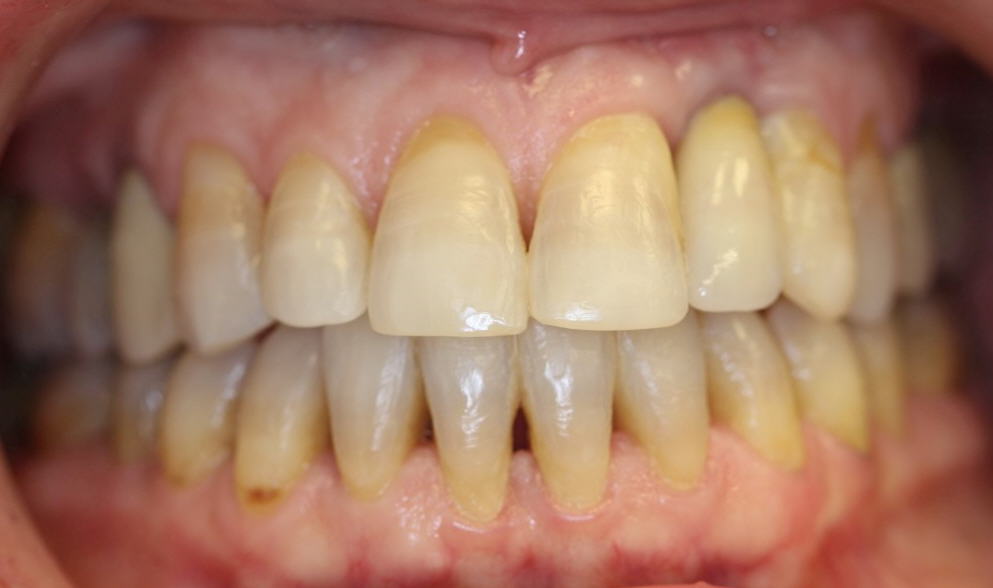 דוגמה ליישור שיניים מוצלח במבוגרים