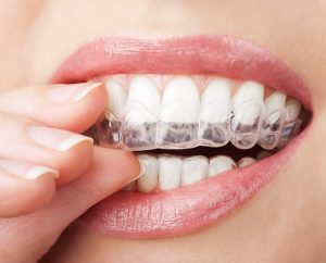 פלטות שקופות INVISALIGN